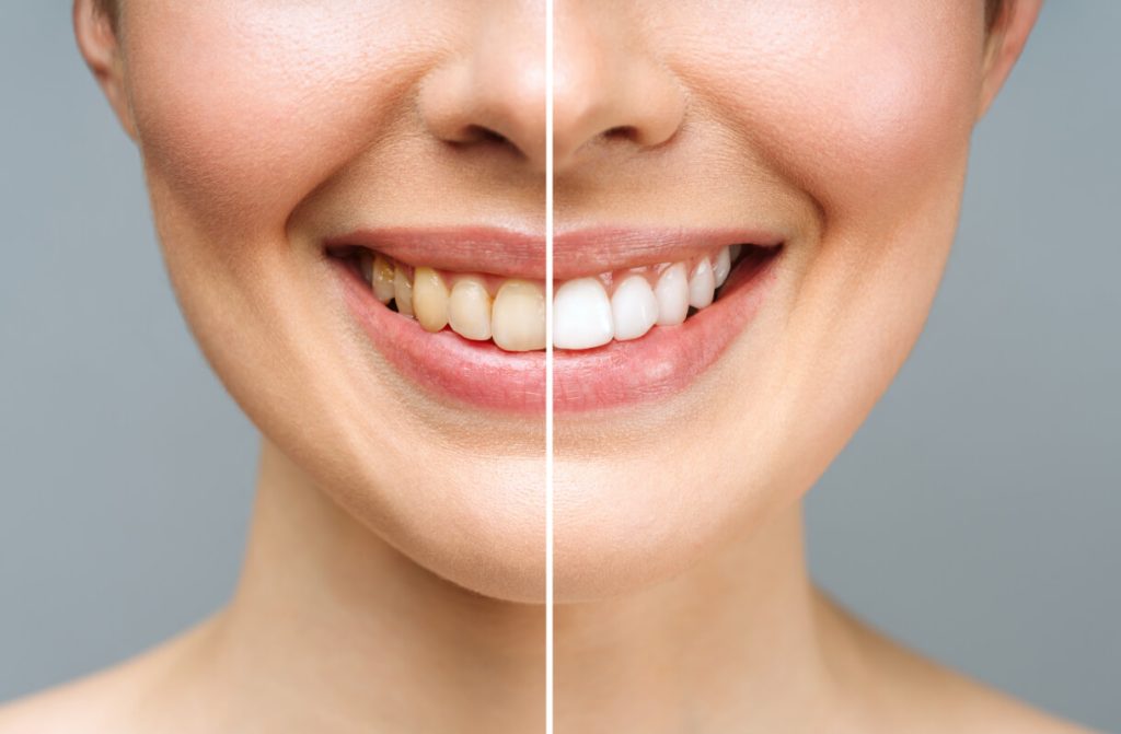 before and after teeth whitening from a dentist