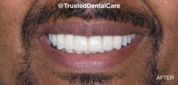 After dental treatment at Trusted Dental Care - Wylie dentist near you